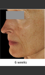 DefenAge Skincare Clinical Power Trio Physician- Prejuvenation Before & After