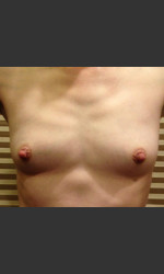 Dr. Palmer Breast Augmentation 01  Physician - Prejuvenation before & after