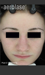 NeoClear by Aerolase Acne Treatment Physician- Prejuvenation Before & After