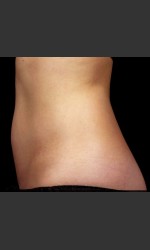 SculpSure Abdomen Physician - Prejuvenation Before & After