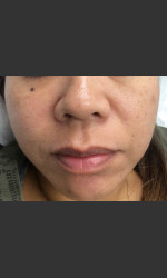 IPL Photofacial  Physician - Prejuvenation Before & After