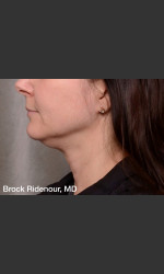  Physician - Prejuvenation before & after