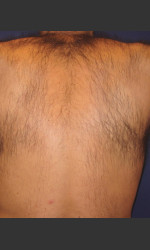 Laser Hair Removal Physician- Prejuvenation before & after