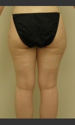 Dr. Langdon Liposuction  Physician- Prejuvenation before & after