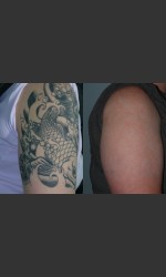 Tattoo Removal Physician - Prejuvenation before & after