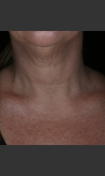 before_after/alastin-skincare-restorative-neck-complex-with-trihex-technology®/17042 Physician- Prejuvenation Before & After