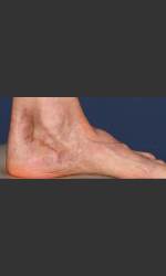Treatment of Pigmented Lesion on Foot Physician - Prejuvenation before & after