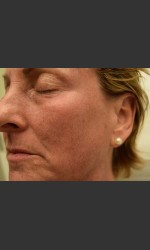 Fraxel Laser Treatment for Pigmentation Physician- Prejuvenation before & after