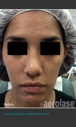 NeoClear by Aerolase Acne Treatment Physician - Prejuvenation before & after