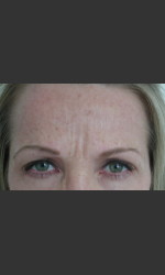 Serene Procedure (Nuebelle) Physician - Prejuvenation before & after