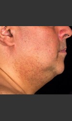 SculpSure Submental Physician- Prejuvenation Before & After