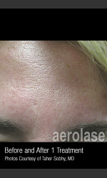 Treatment of Pores and Skin Texture #338 Physician - Prejuvenation before & after