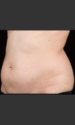  Physician - Prejuvenation before & after