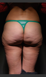 Cellfina Case #2 Physician- Prejuvenation before & after