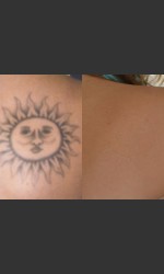 Tattoo Removal Physician - Prejuvenation Before & After