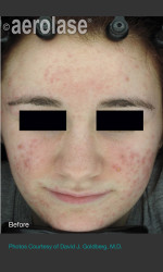 NeoClear by Aerolase Acne Treatment Physician - Prejuvenation before & after