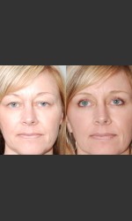 Two women with Laser Eyelid Blepharoplasty Physician - Prejuvenation Before & After