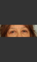 Eyelid Surgery Physician - Prejuvenation Before & After