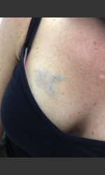 Laser Tattoo Removal  Physician- Prejuvenation Before & After