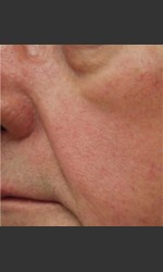 Dr. Langdon IPL Treatment  Physician- Prejuvenation Before & After