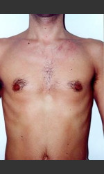 Quanta Light Series Laser Hair Removal #74 Physician - Prejuvenation before & after