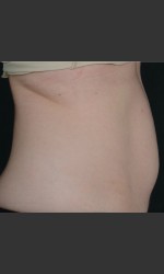 SculpSure Abdomen Physician - Prejuvenation before & after