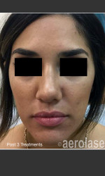 NeoClear by Aerolase Acne Treatment Physician - Prejuvenation Before & After