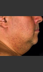 SculpSure Submental Physician- Prejuvenation before & after