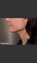 ThermiTight Treatment Physician- Prejuvenation Before & After