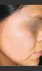 Quanta MDK Nevus of Ota Treatment #76 Physician- Prejuvenation Before & After