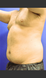 Liposuction Case #1 Physician - Prejuvenation before & after