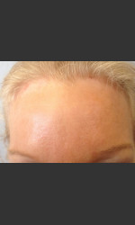 Before & After Botox Physician - Prejuvenation Before & After