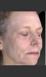 Wrinkle and Brown Spot Reduction Physician- Prejuvenation Before & After