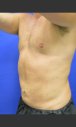 Liposuction Case #1 Physician - Prejuvenation Before & After