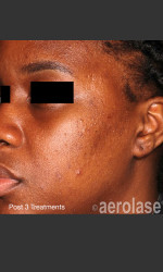 NeoClear by Aerolase Acne Treatment Physician - Prejuvenation Before & After