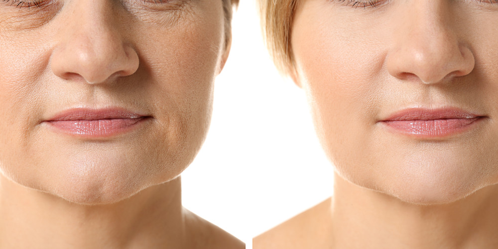 What is the Cost of Wrinkle Reduction Treatments? - Prejuvenation Article Banner