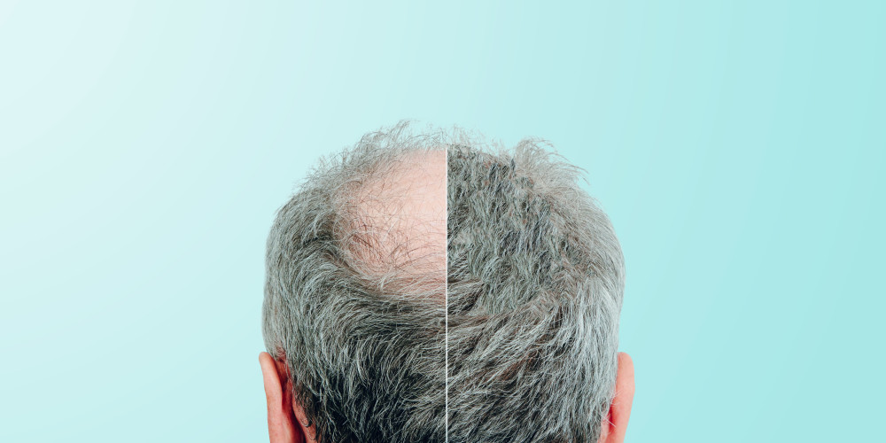 The Price of Hair Restoration - Prejuvenation Article Banner