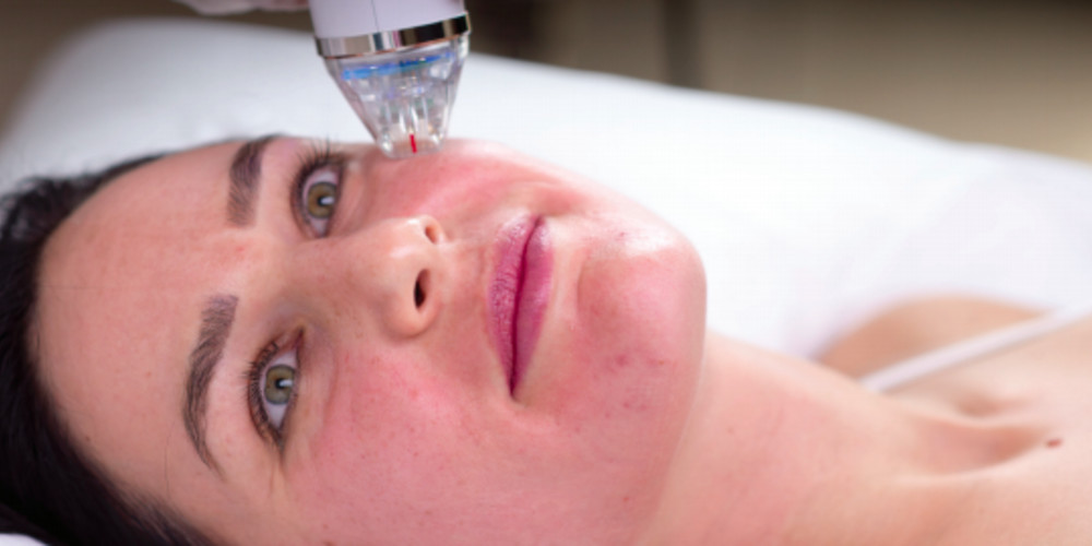 Intensif Review: Micro Needling & Acne Treatment - Prejuvenation Article Banner