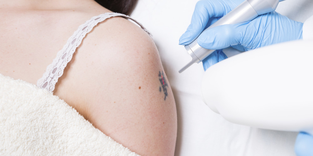 9 Tips for Tattoo Removal | ZALEA