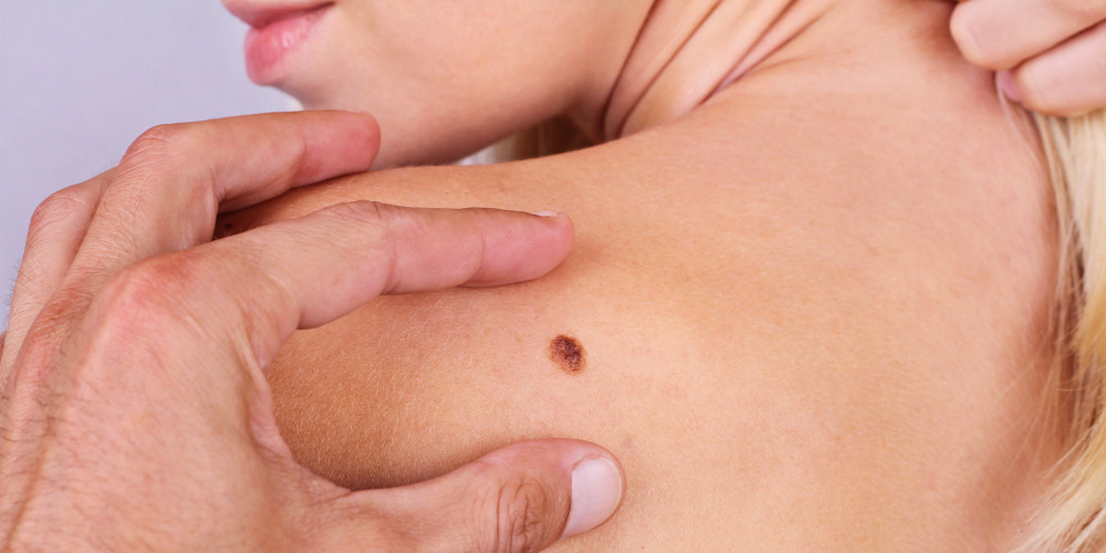 A Helpful Guide to Scan for Early Signs of Skin Cancer - Prejuvenation Article Banner