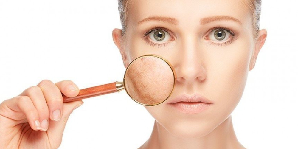 Summer Basics for Melasma - Prejuvenation Article Banner