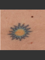 Before Photo Treatment of Tattoo - Prejuvenation Before & After