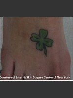 Before Photo Treatment of Foot Tattoo - Prejuvenation Before & After