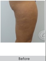 Before Photo VanquishME with Cellutone Treatment - Prejuvenation Before & After