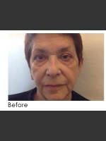 Before Photo Radiesse and Restylane Filler Treatment - Prejuvenation Before & After
