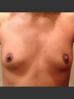 Before Photo Dr. Palmer Breast Augmentation 02 - Prejuvenation Before & After