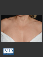 After Photo IPL Brown Spots Treatment 108 - Prejuvenation Before & After