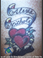 Before Photo Treatment of Arm Tattoo - Prejuvenation Before & After