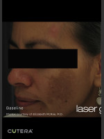 Before Photo Melasma Before & After Photo after Laser Genesis - Prejuvenation Before & After