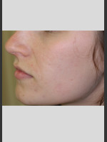 After Photo Sublative Rejuvenation Treatment - Prejuvenation Before & After